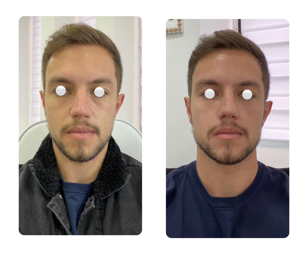 Antes e depois do Protocolo Lifteyes, paciente 2