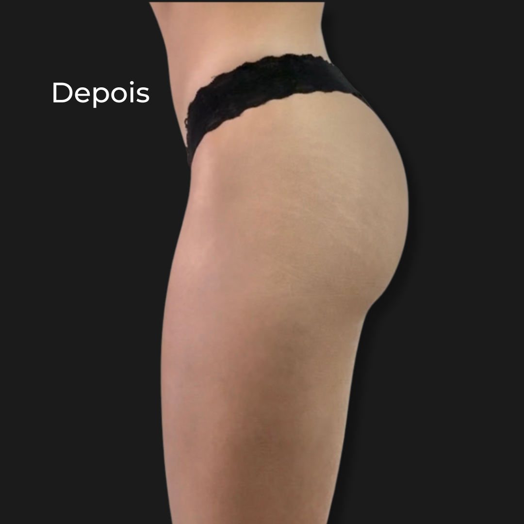 Depois do protocolo GlúteoUpMax