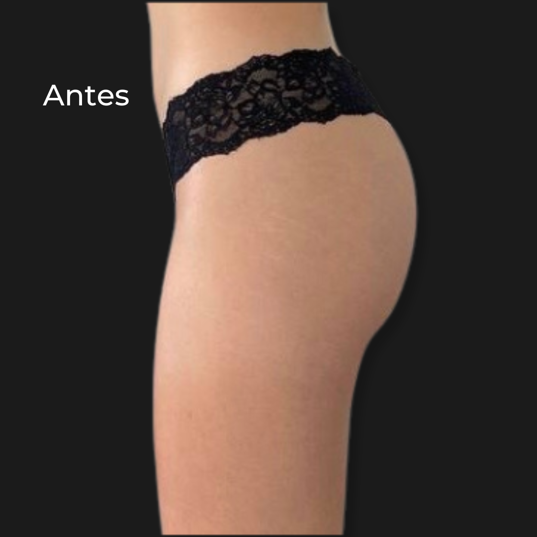 Antes do protocolo GlúteoUpMax