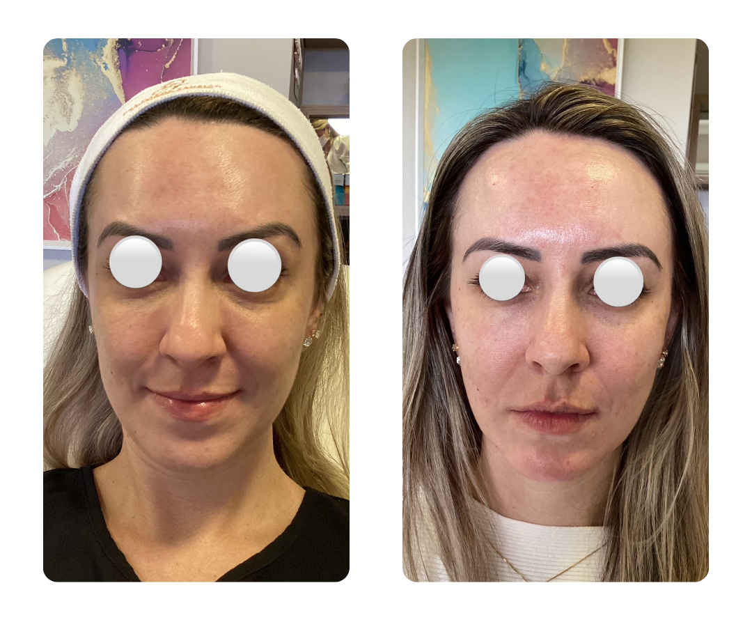 Antes e depois do Protocolo Lifteyes, paciente 3