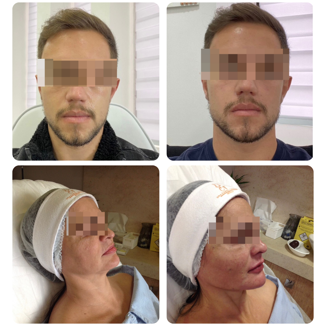 Antes e depois de procedimento facial, paciente 1