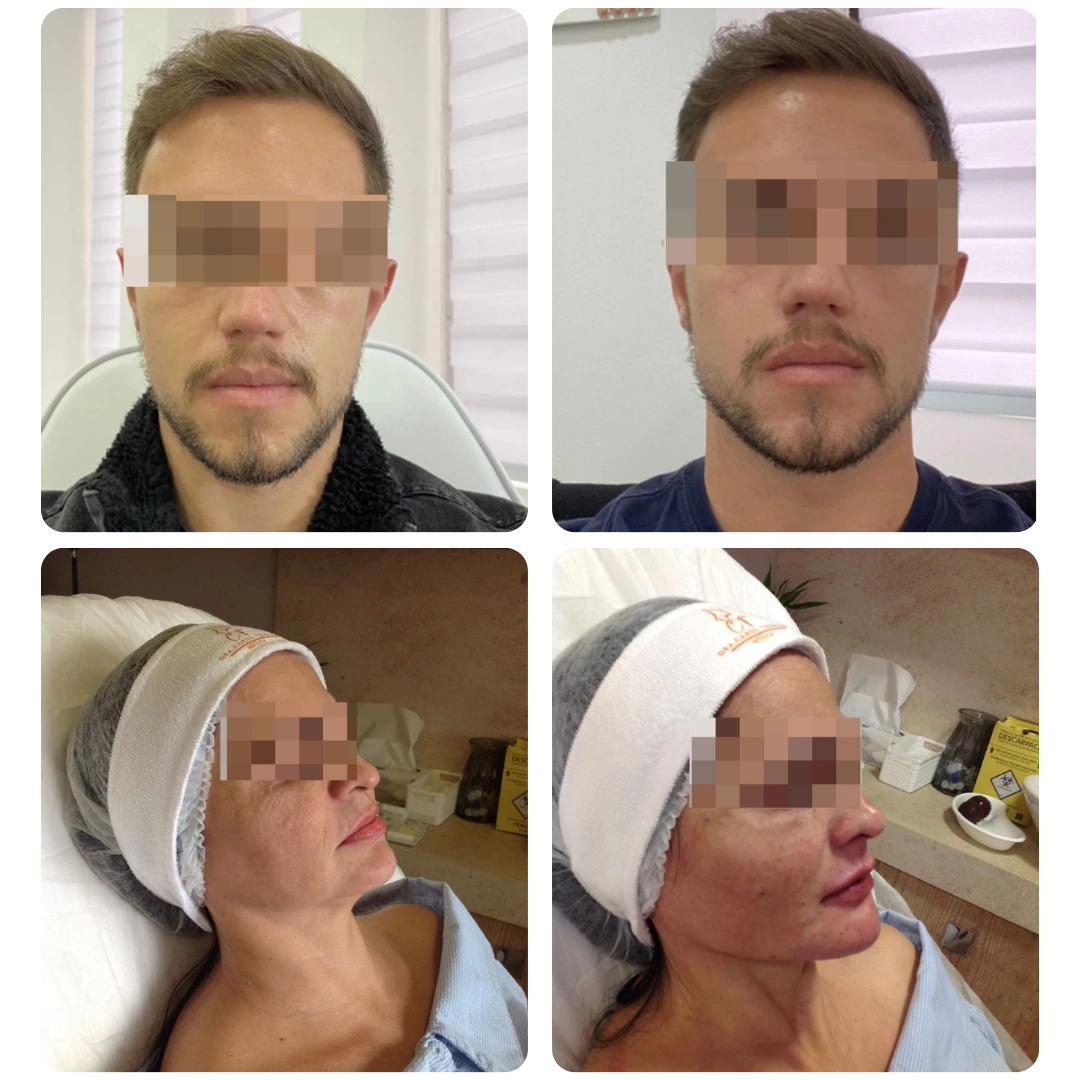 Antes e depois de procedimento facial, paciente 1