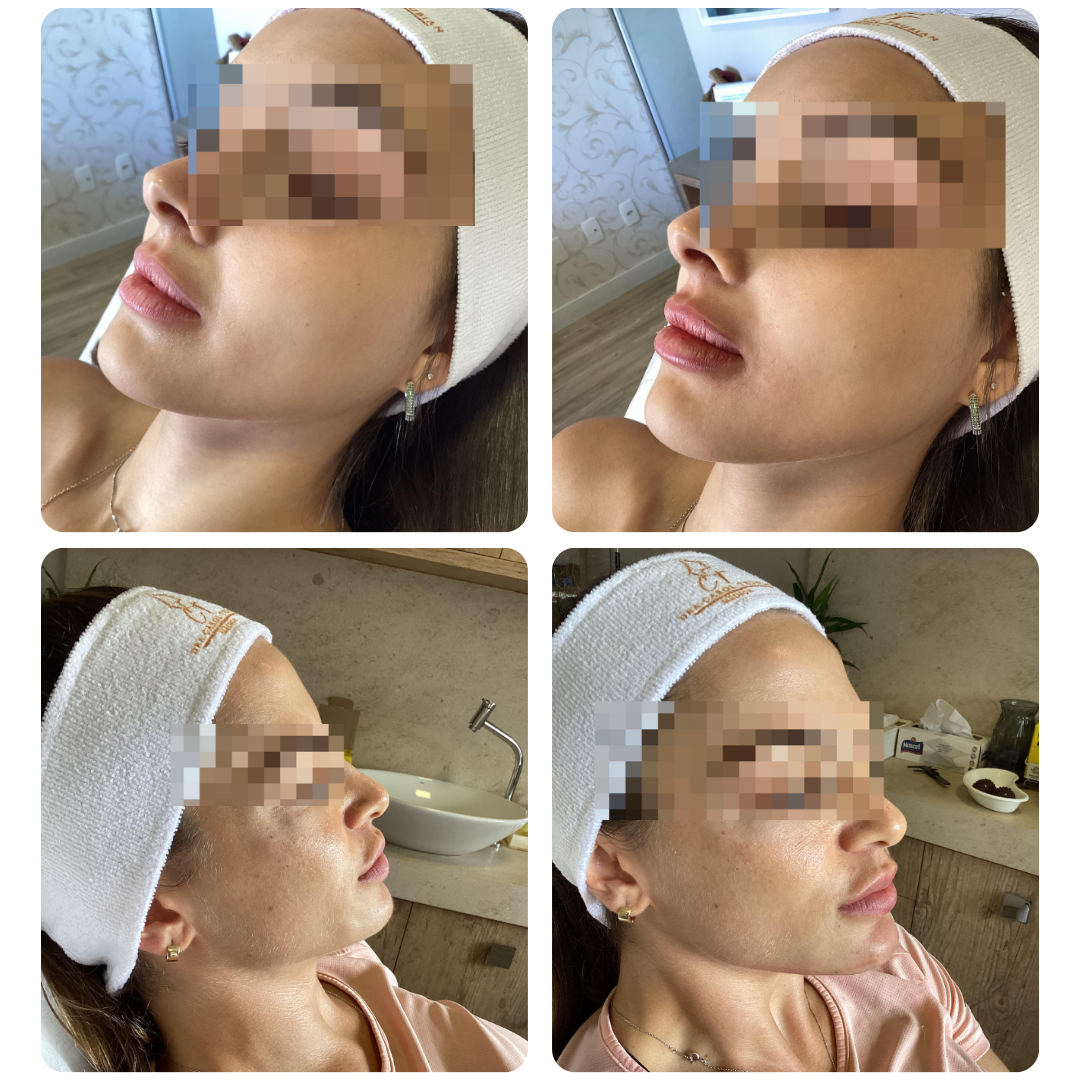 Antes e depois de procedimento facial, paciente 2