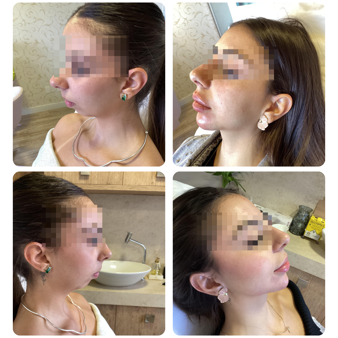 Antes e depois de procedimento facial, paciente 3