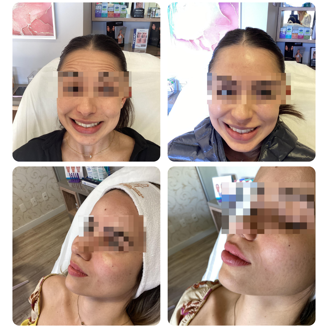 Antes e depois de procedimento facial, paciente 4