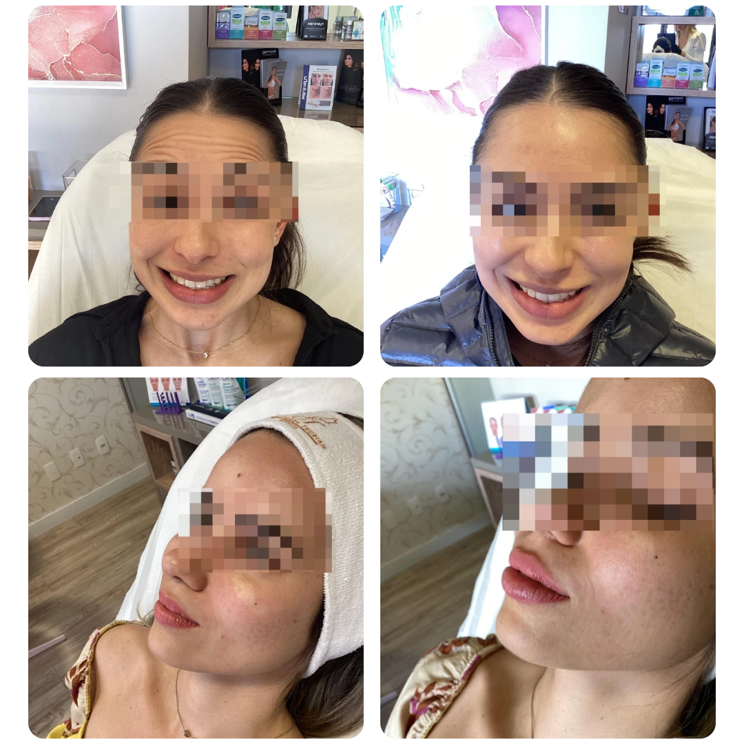 Antes e depois de procedimento facial, paciente 4
