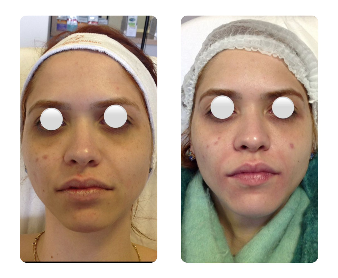 Antes e depois do Protocolo Lifteyes, paciente 1