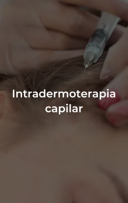 Intradermoterapia capilar